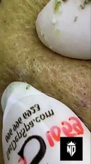 HIDDEN METHOD REVEALED! Revolutionary Acne Therapy Technique [sacdepspa]