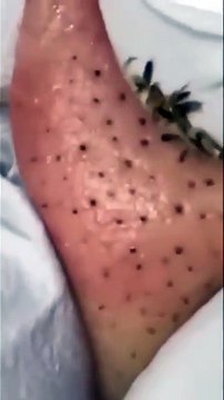 SHOCKING! How to Remove GIANT Blackheads on Your Nose! [sacdepspa ASMR]