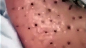 SHOCKING! How to Remove GIANT Blackheads on Your Nose! [sacdepspa ASMR]