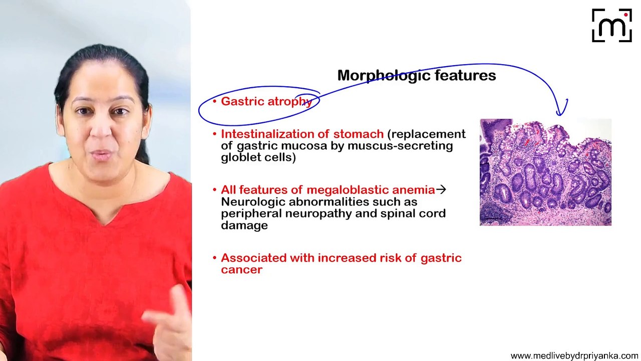 16. Pernicious Anemia