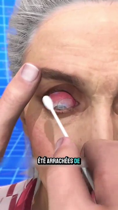 Des lentilles dans l’oeil