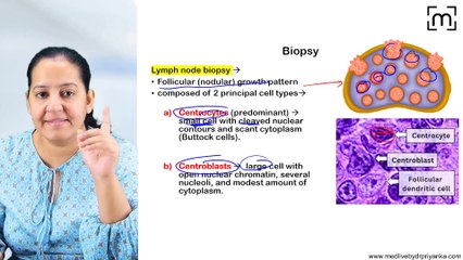 11. Non Hodgkin's Lymphoma