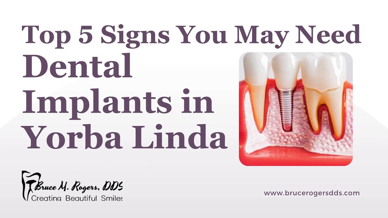 Top 5 Signs You May Need Dental Implants in Yorba Linda