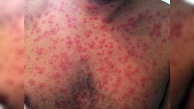 Centro educativo del Distrito Nacional cierra un curso por brote de varicela