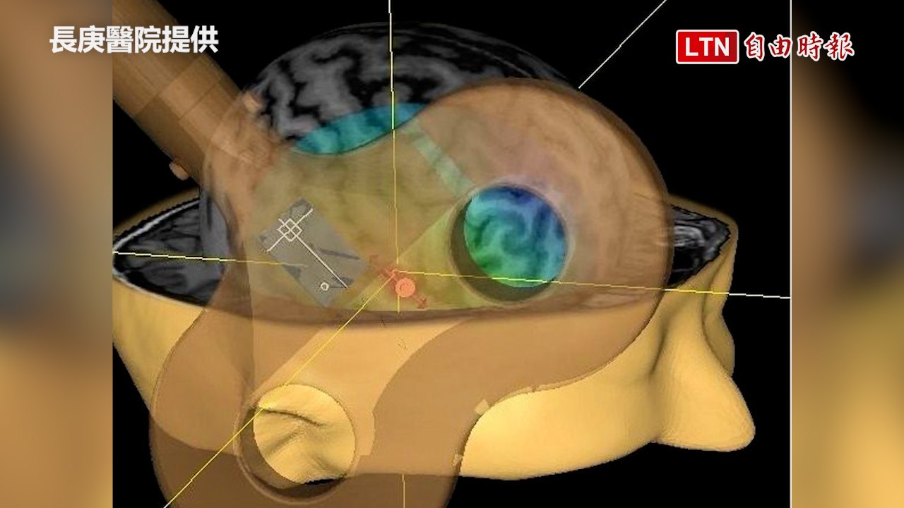 自閉症治療露曙光！長庚最新研究 顯著提升社交認知功能