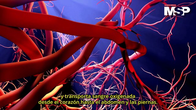 Hombre enfrenta síndrome de leriche: Dentro de la enfermedad arterial periférica