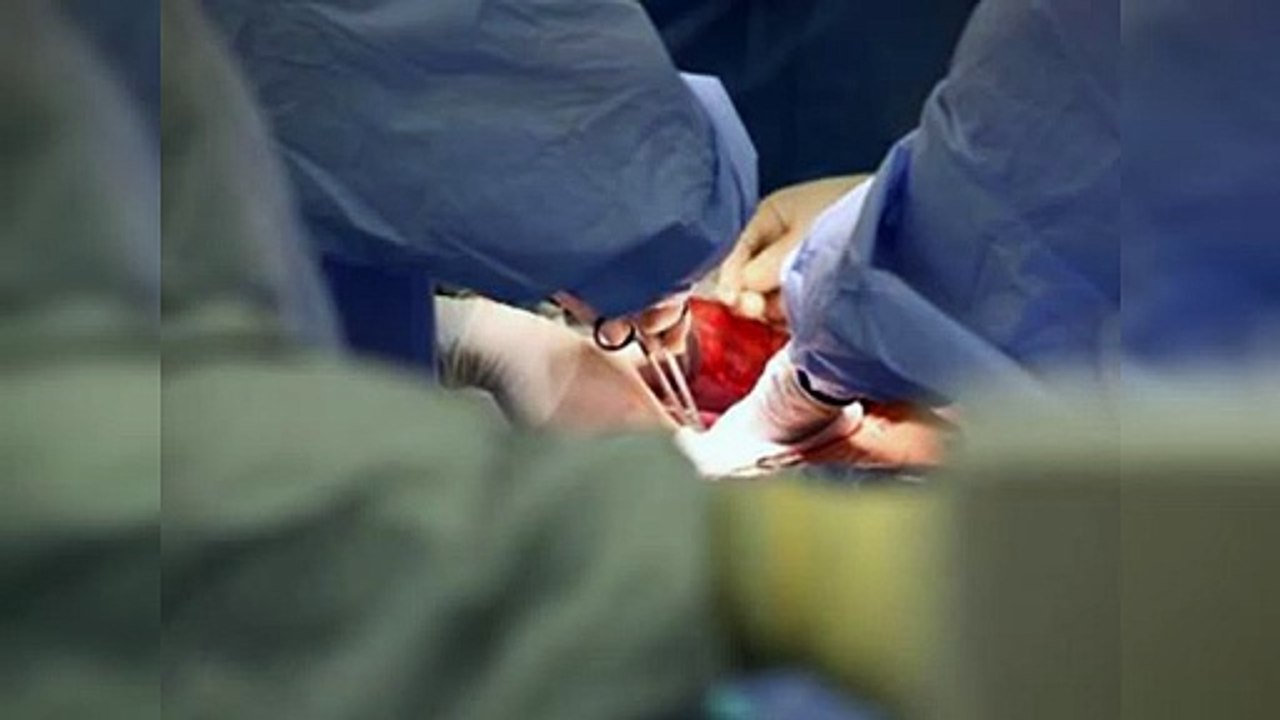 Cleveland Clinic a favor de transplantes de donantes vivos de órganos