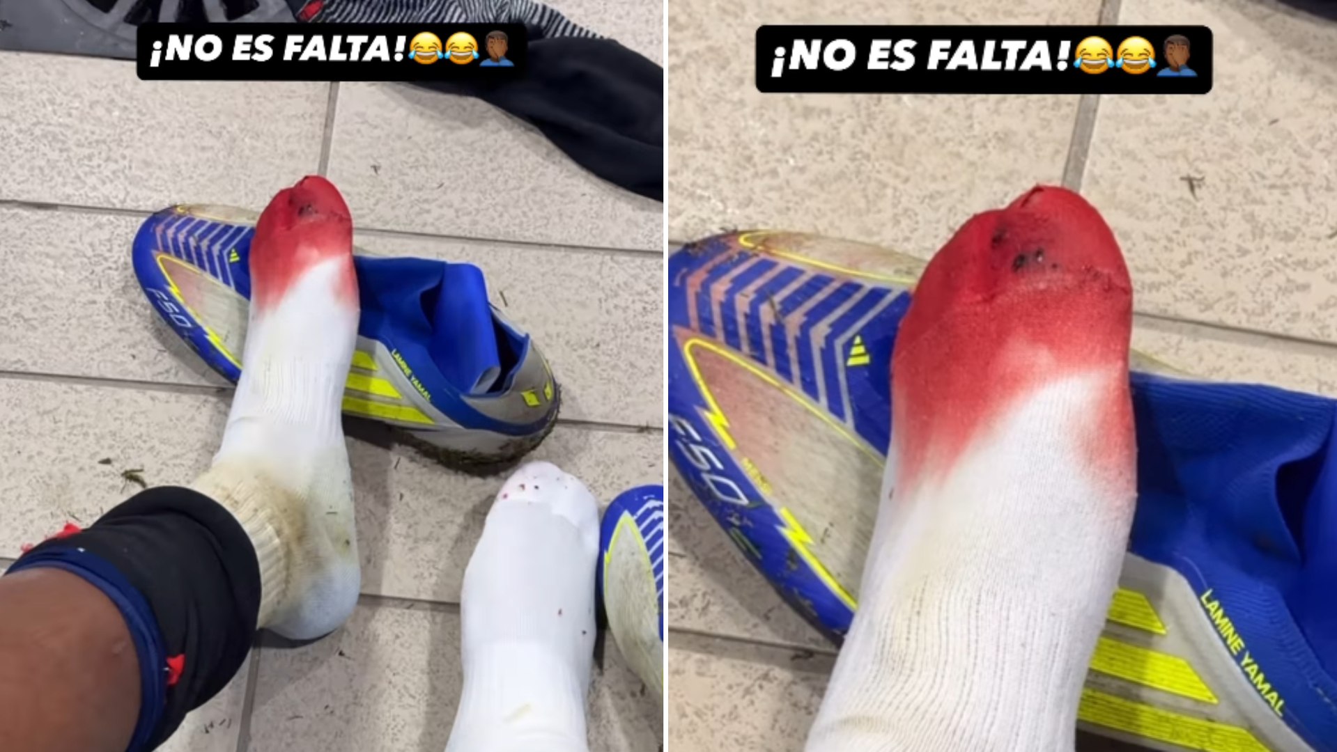 Lamine Yamal muestra su pie ensangrentado e ironiza con el pisotón