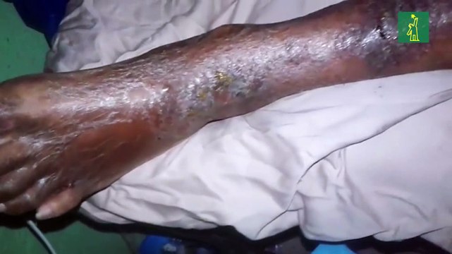 Señora enferma de neuropatía diabética solicita ayuda