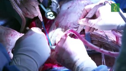 Realizan trasplante doble de pulmón "covid a covid" en Chicago