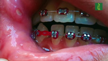 Nuestra salud: cómo tratar las molestosas aftas