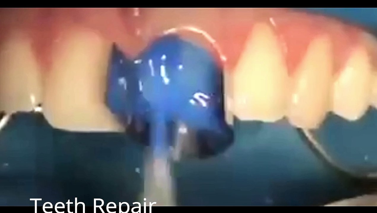 Teeth Repairs