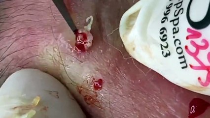 ASMR Blackhead Removal: Intense Care for Nose & Chin!