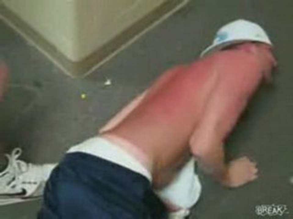 Claque sur un coup de soleil