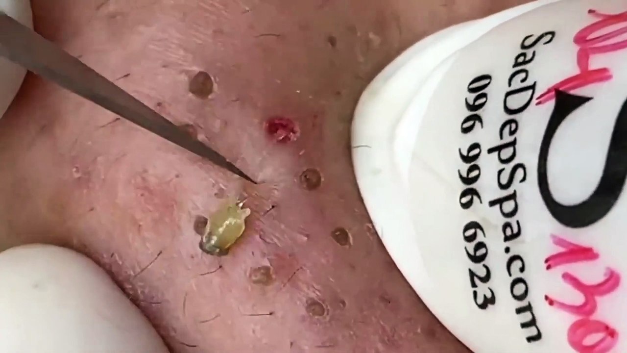 Sacdepspa Facial Treatment: Blackhead Removal, Acne Therapy & Skin Rejuvenation