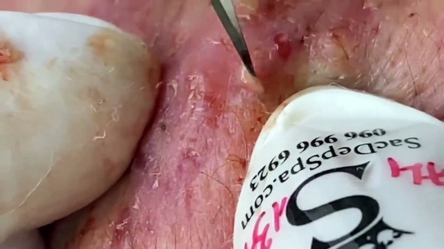 Blackheads on Nose? Expert Acne Therapist Shows the BEST Extraction Techniques!