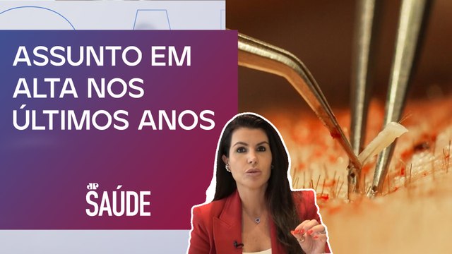 Quais principais técnicas de transplante capilar no Brasil? | Dra. Ana Carina