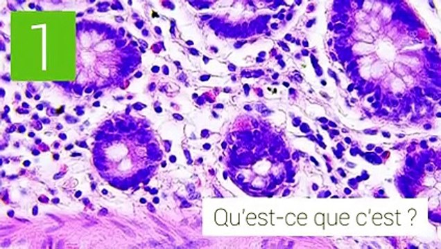 Cancer du côlon (cancer colorectal)