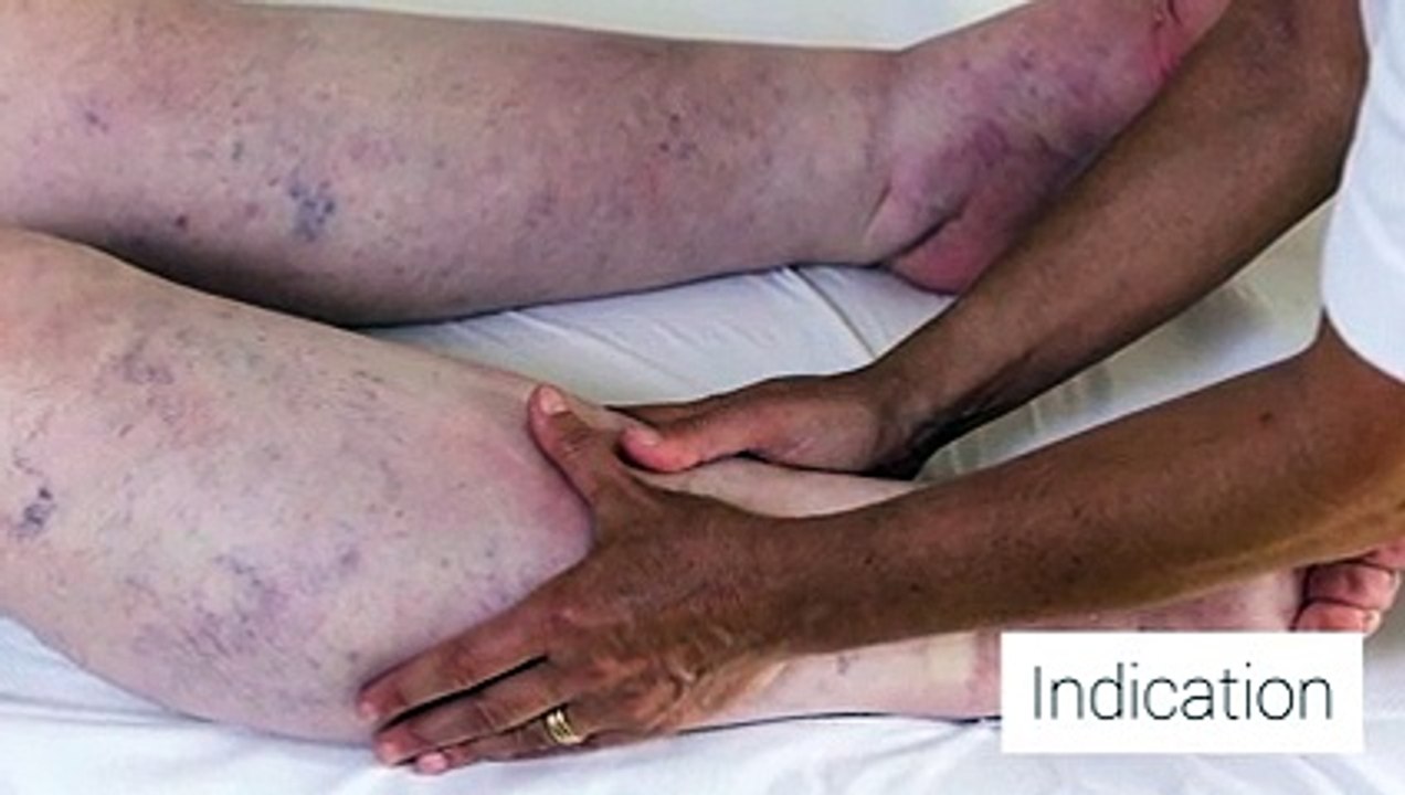 Le drainage lymphatique manuel