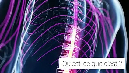 La sclérose en plaques