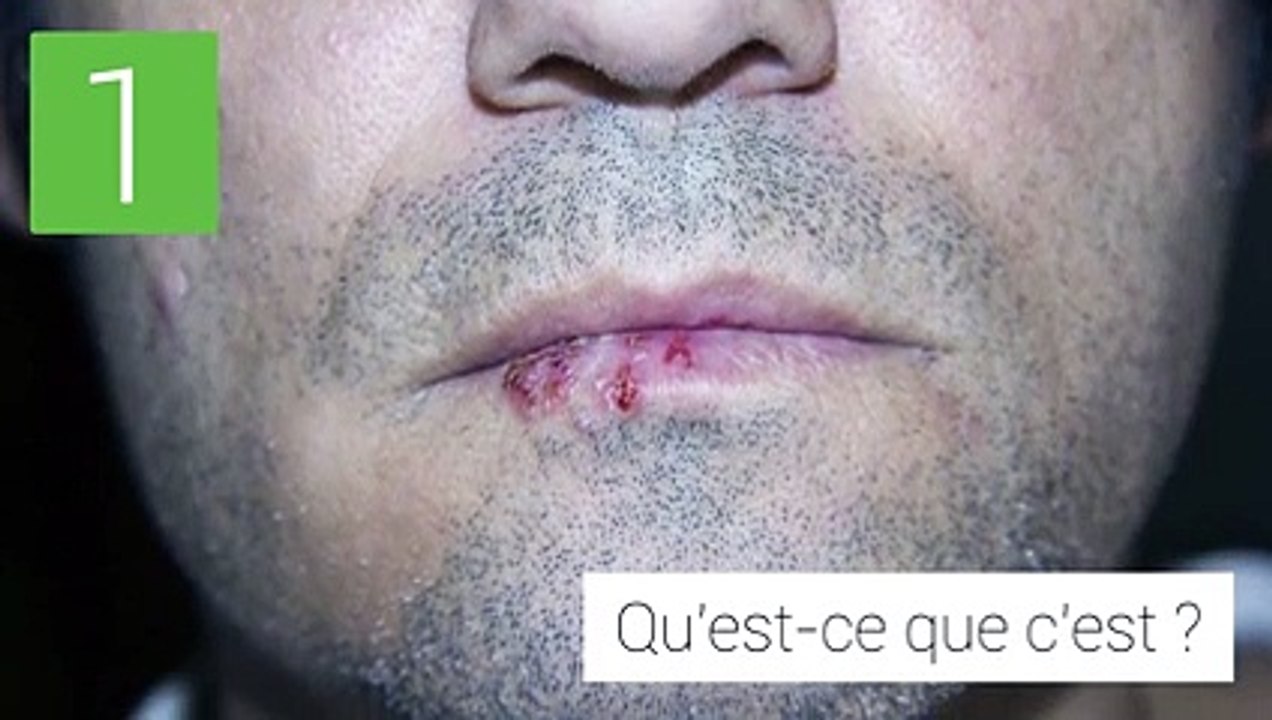 L'herpès labial