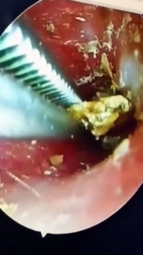 ASMR Sakdepspa Facial | The Ultimate in Acne and Blackhead Removal! (Professional Therapists)