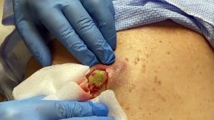 Breathtaking Blackhead Extraction | Nose Area Miracle with Sakdepspa ASMR Facial!