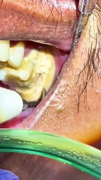 Satisfying Blackhead Removal Compilation | ASMR Triggers for Relaxation and Skin Care