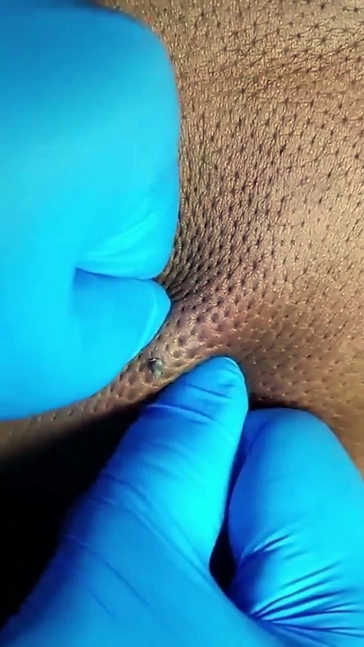 ASMR Treatment Wajah (Facial) for Acne-Prone Skin | Expert Care at Sakdepspa