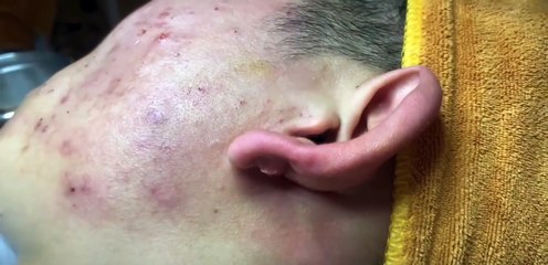 Gentle ASMR Acne Therapy | Calming Facial Treatment for Sensitive Skin