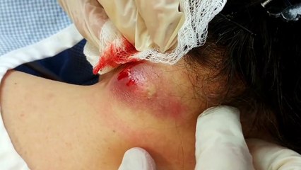 Acne Treatment Journey at Sakdepspa | ASMR Facial Transformation