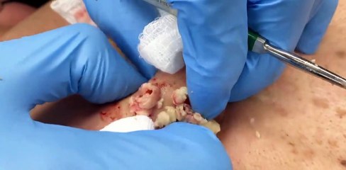 Why You Should Get a Professional Facial for Acne (ASMR)