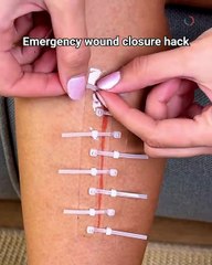 Close wounds fast without medical tools