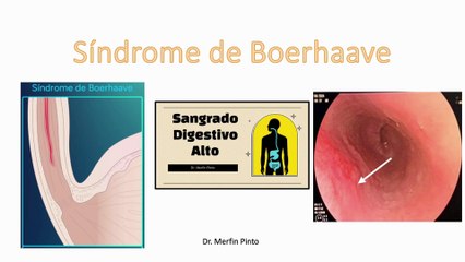 Síndrome de Boerhaave #elcuerpoymas #medicina #salud #sangradodigestivo
