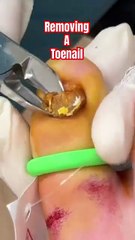 How to remove a Toenail! 🤣 NOT MEDICAL ADVICE