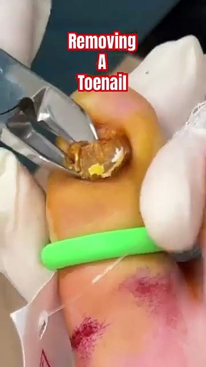 How to remove a Toenail! 🤣 NOT MEDICAL ADVICE