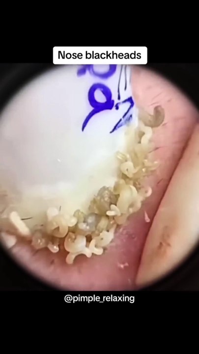 SATISFYING BLACKHEADS COMPILATION,  Clearing the Way Effective Blackhead Removal Techniques (17)