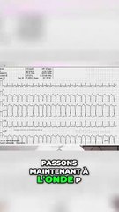 Comprendre la Fibrillation Auriculaire _ Onde P et QRS