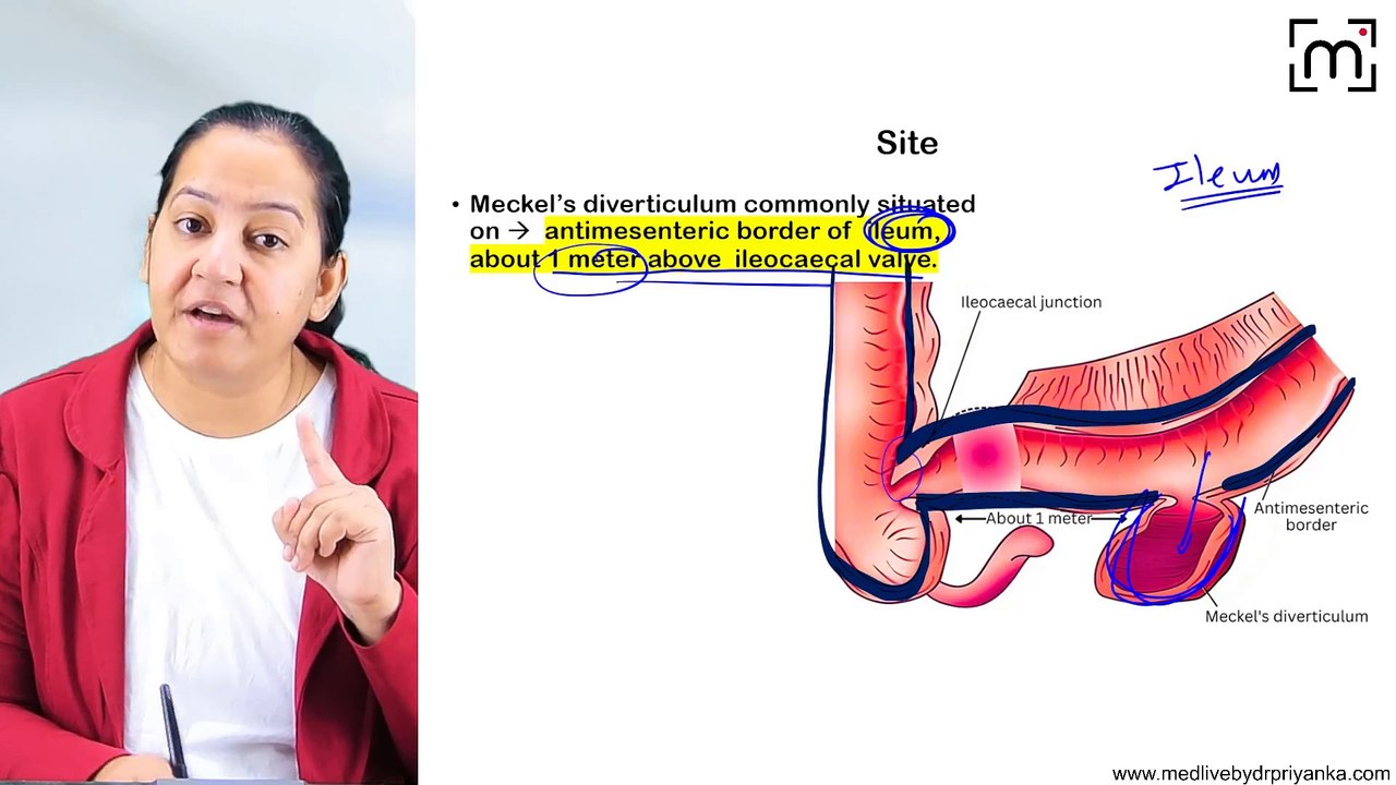 10. Meckel's Diverticulum