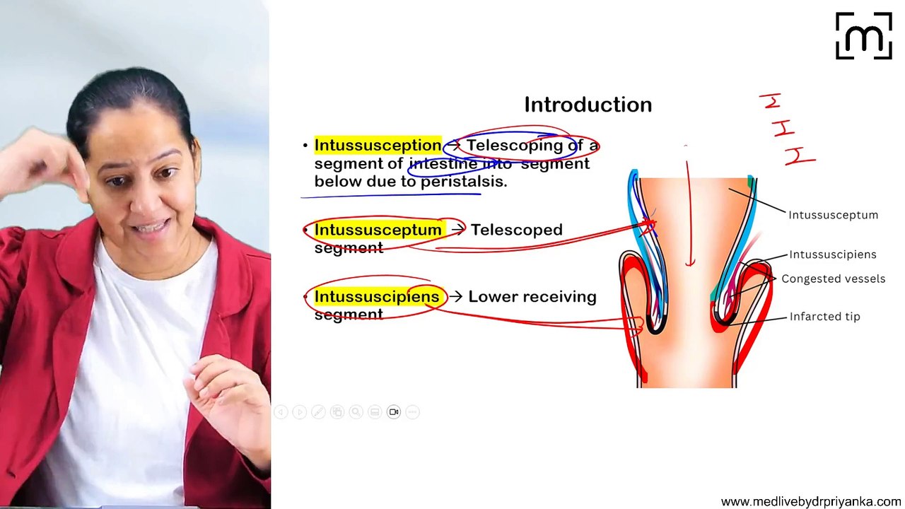 11. Intussusception