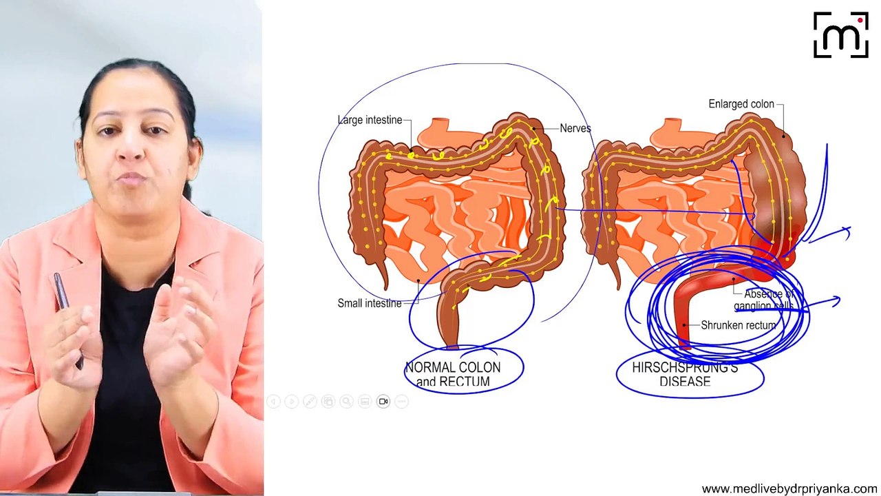 17. Hirschsprung's Disease