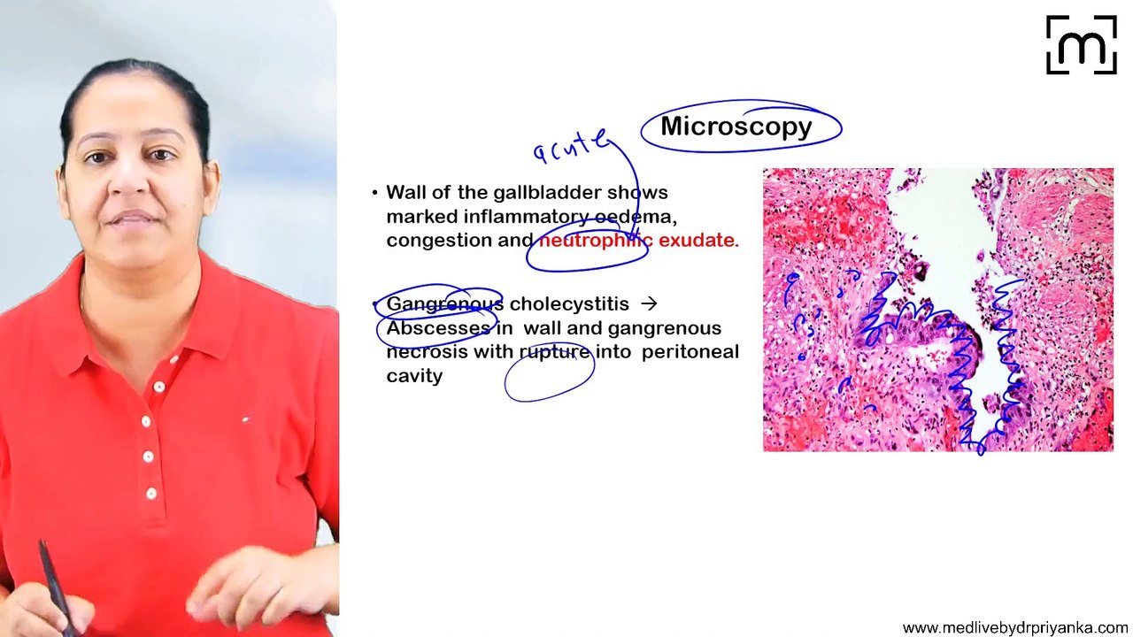 14. Cholecystitis