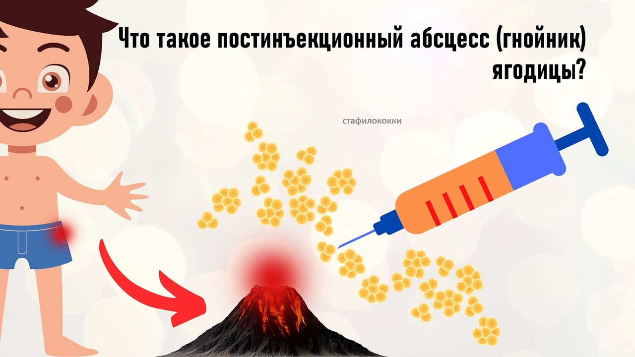 Операция вскрытия постинъекционного абсцесса ягодицы: материалы, инструменты и ход операции
