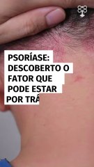Psoríase: descoberto o fator que pode estar por trás da doença