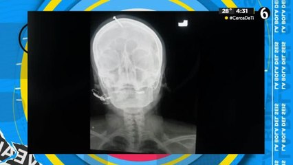 Mujer embarazada se clava un clavo en la cabeza