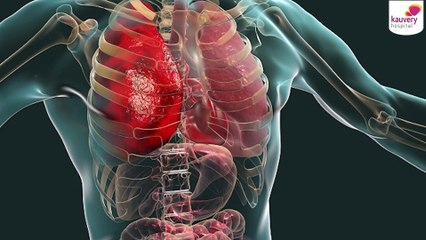 Understanding Continuous Renal Replacement Therapy (CRRT): When and How It Saves Lives 💉