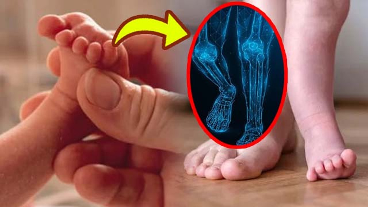 Bilateral Congenital Pseudoarthrosis Tibia: Newborn Baby का Bone Fracture, Causes & Symptoms..