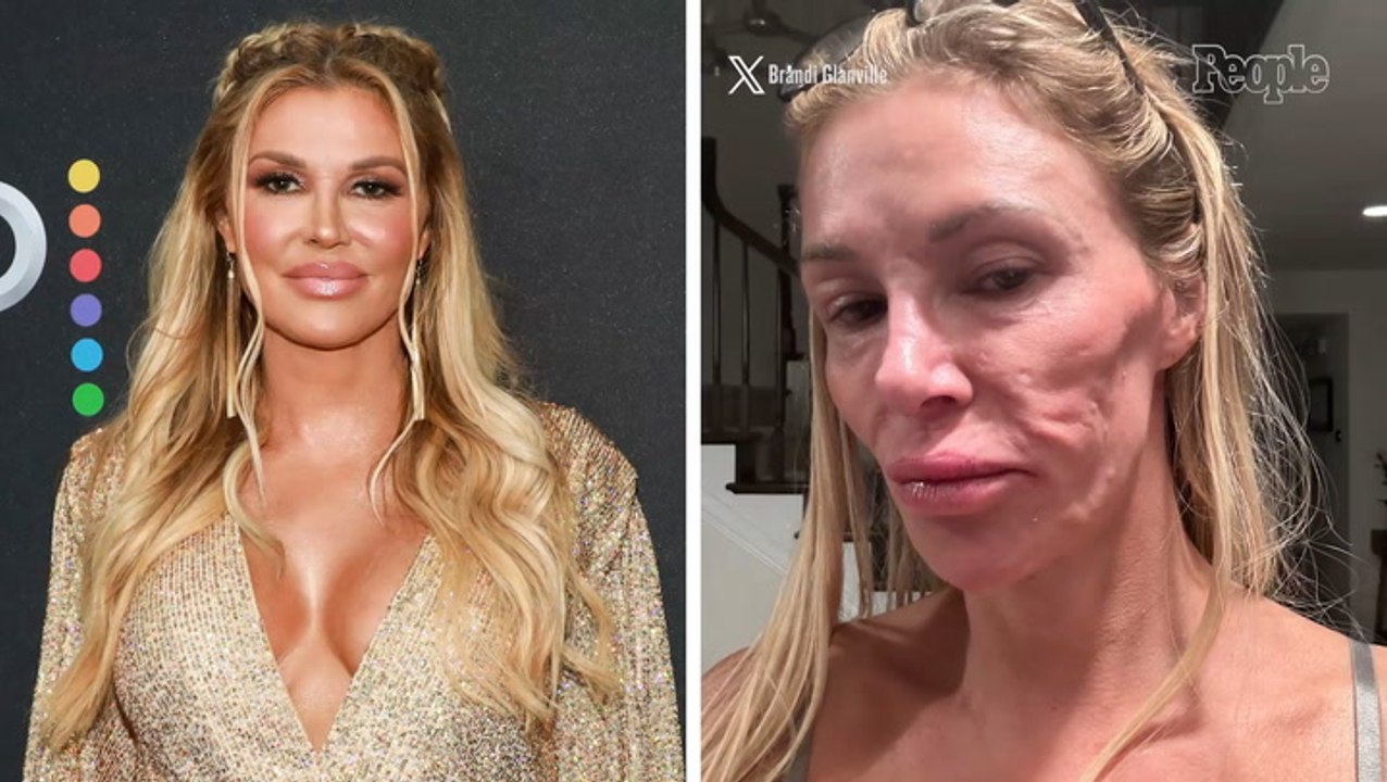 Brandi Glanville Says There's an 'Oily Foul-Tasting Drainage' from Her Face That's 'Eating Away at My Teeth'
