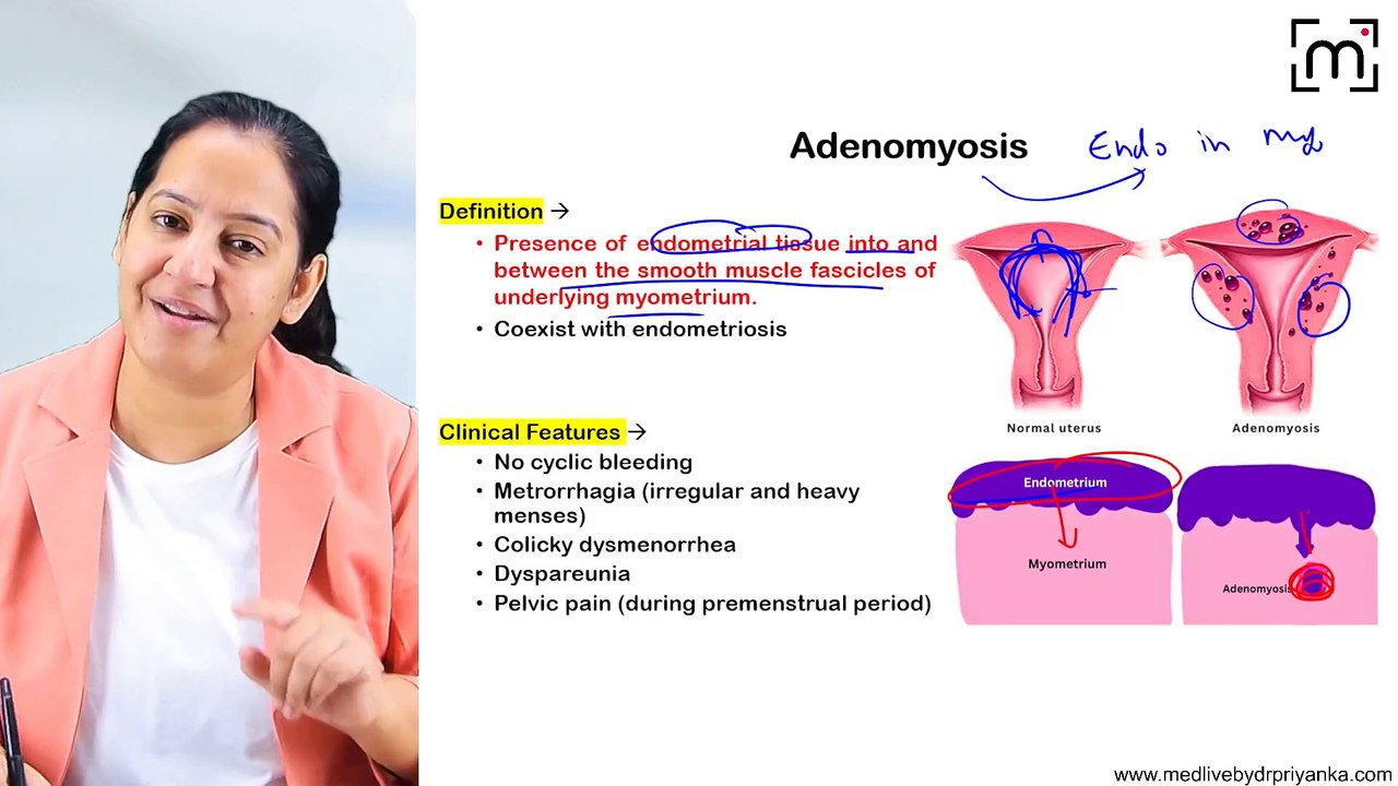 4. Adenomyosis