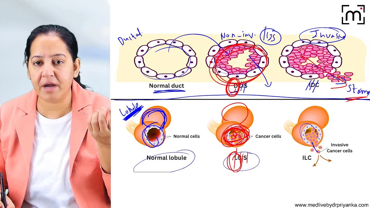 2. Breast Carcinoma